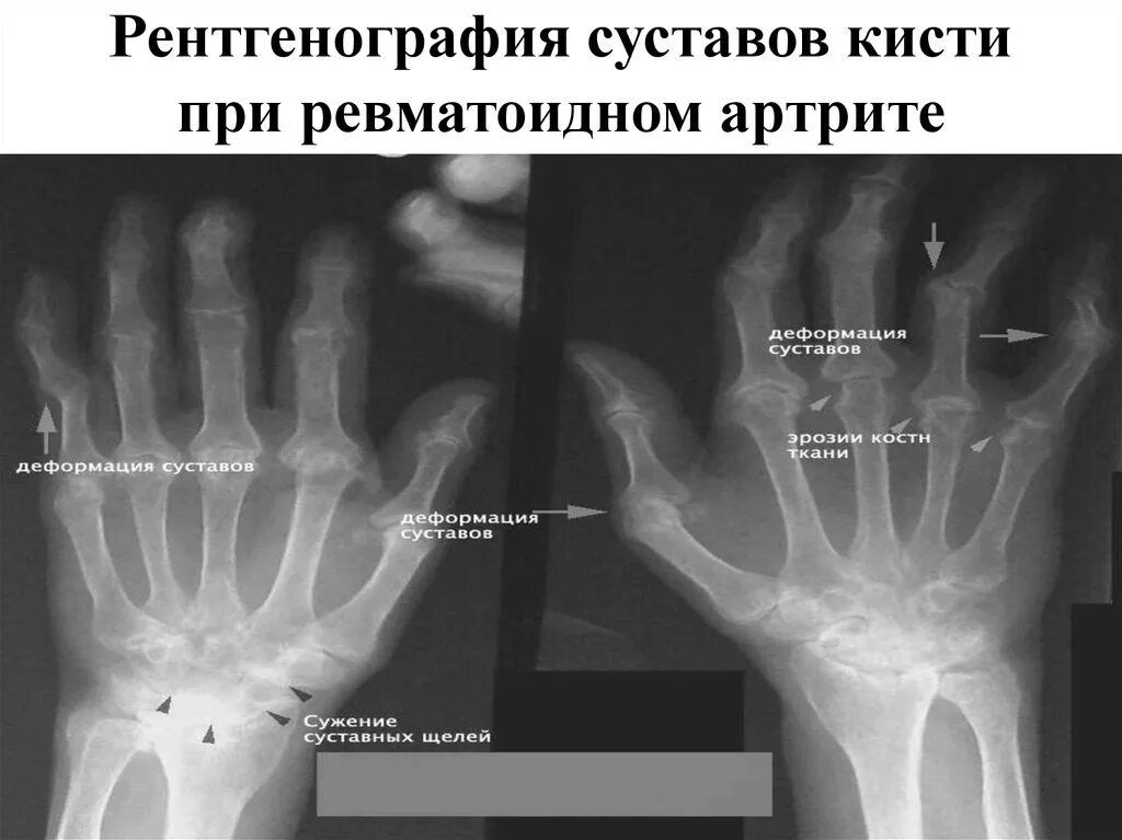 Артрит рентгенологические стадии. Артрит запястного сустава рентген. Ревматоидный артрит кисти рентген. Ревматоидный артрит рентген кистей рук заключение. Ревматоидный артрит лучезап суставов рентген.