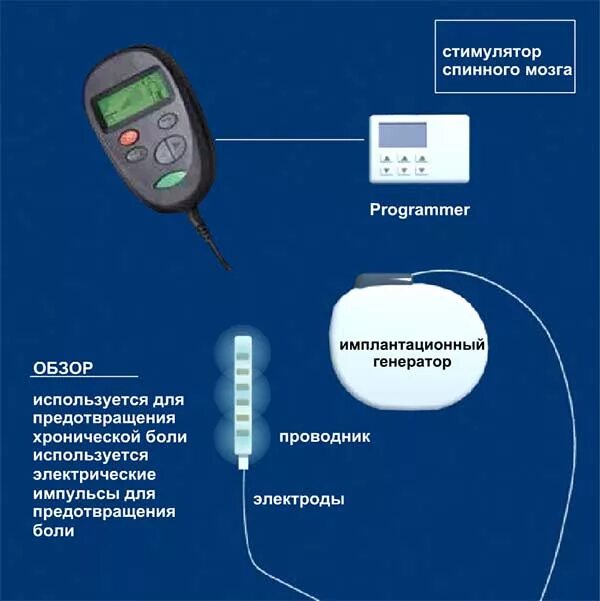 Стимулятор спинного мозга. Приборы для электрической стимуляции мозга. Нейростимуляция спинного мозга. Электростимулятор спинного мозга.