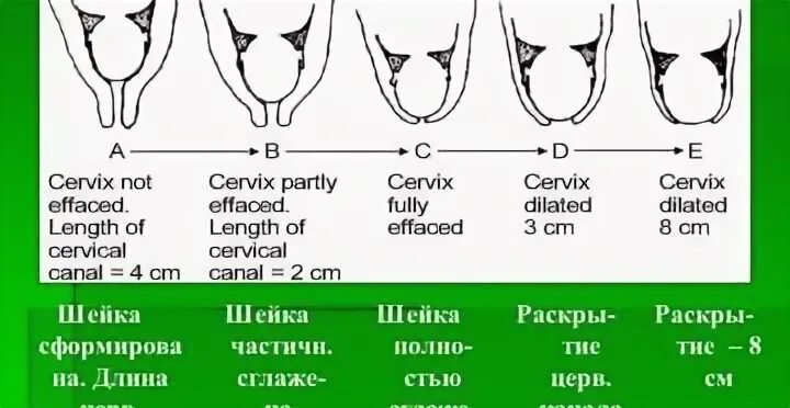 Почему укорачивается матка. Укорочение шейки матки. Шейка матки при беременности.