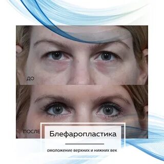 Отзывы о блефаропластике верхних век