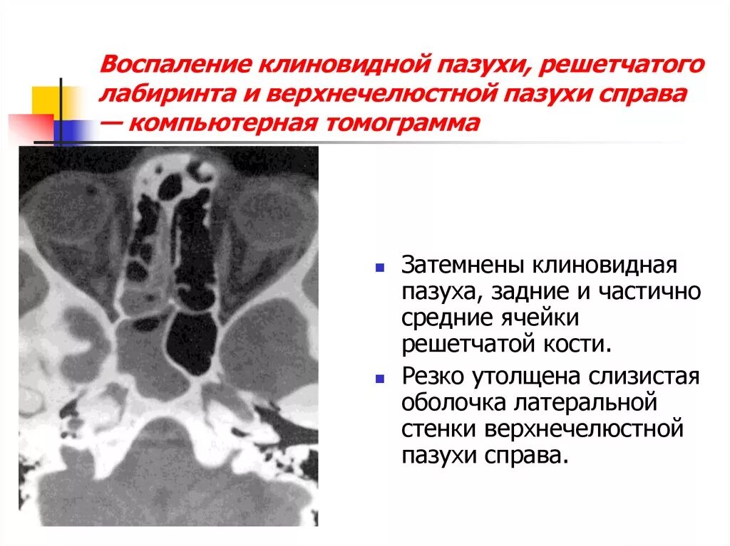Содержимое в основной пазухе