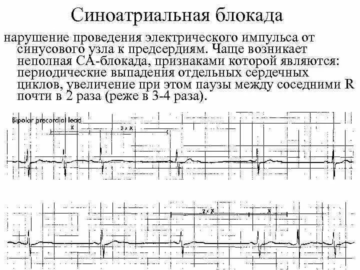 Блокада узла. Блокада са узла ЭКГ. ЭКГ признаки синоатриальной блокады. Блокада синусового узла. Ритм синоатриальная блокада.