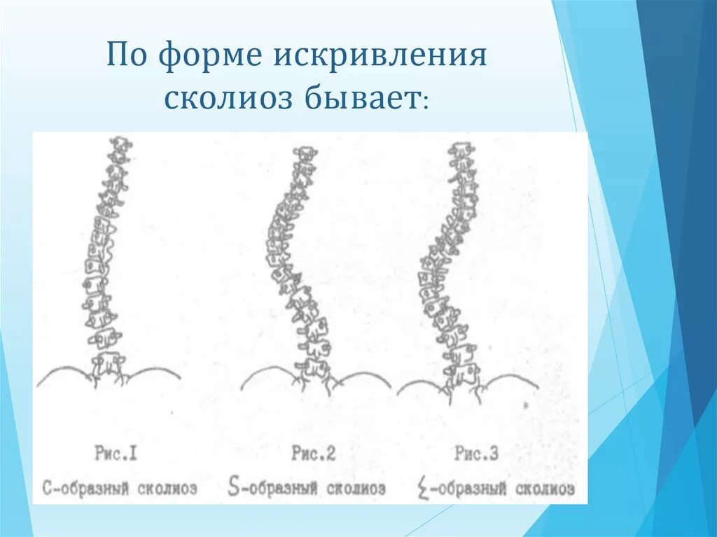 Искривление бывает. Классификация сколиоза по форме искривления. искривление позвоночника, формы сколиоза. сколиоз дуга искривления. w образный сколиоз позвоночника.