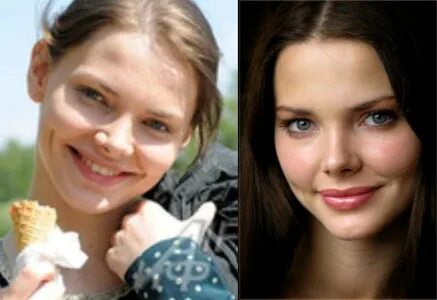 Ринопластика боярской до и после