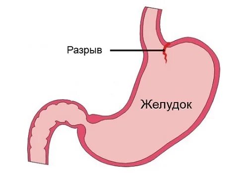 Маркеры желудка. Малори синдром Маллори Вейсса. Синдром Мэллори Вейса картинки. Синдром Маллори-Вейсса это что такое Мэллори Вейса.