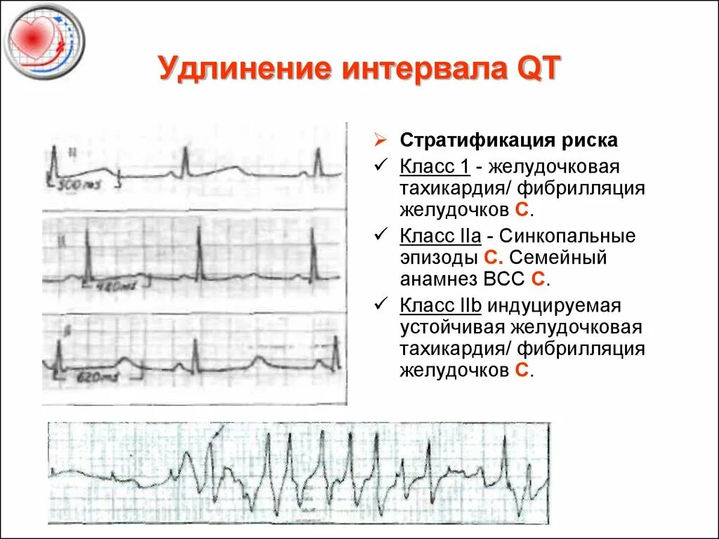 Удлиненное qt на экг