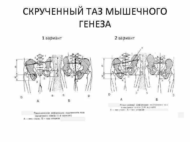 Как исправить таз. Как исправить таз