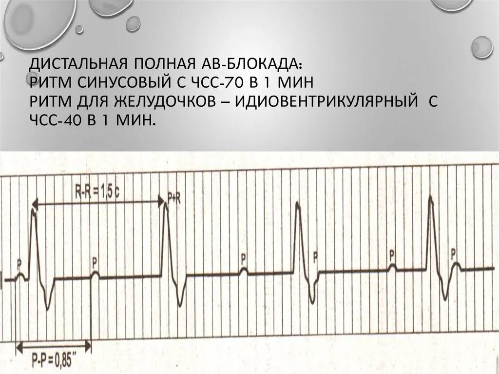 Блокада код по мкб 10. Полная АВ блокада ЧСС. Ритм при полной АВ блокаде. Дистальная полная АВ блокада. Полная АВ блокада частота пульса.