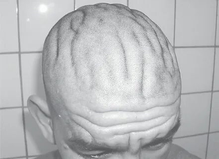Складки на коже головы