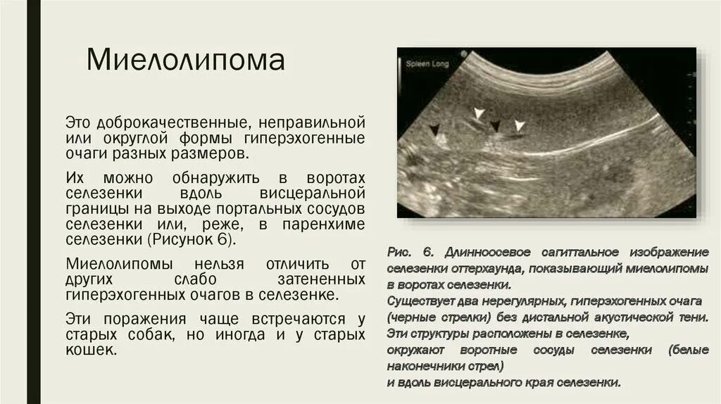 Миелолипома селезенки УЗИ. Миелолипома надпочечника кт. Миелолипома селезенки у кошки. Паренхимы селезенки гиперэхогенная. Цена селезенки