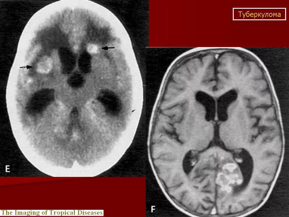 Туберкулема головного мозга на кт. Туберкулёз мозговых оболочек и нервной системы. Туберкулезный менингоэнцефалит кт. Туберкулома головного мозга кт. Нервный туберкулез