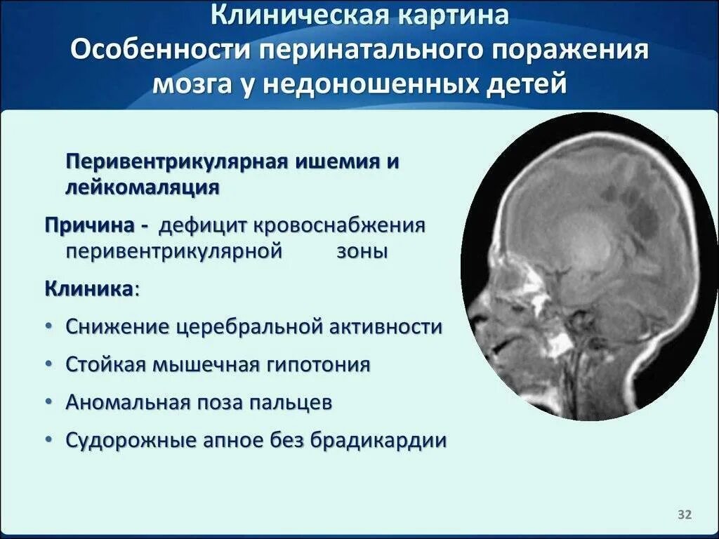 Церебральная ишемия у новорожденного 2. Поражение головного мозга. Перивентрикулярная энцефалопатия. Аноксическое поражение головного мозга это. Поражение головного мозга у детей.