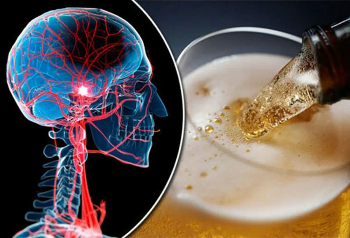 Пиво после инсульта. Алкоголь и нервная система. Пиво и нервная система.