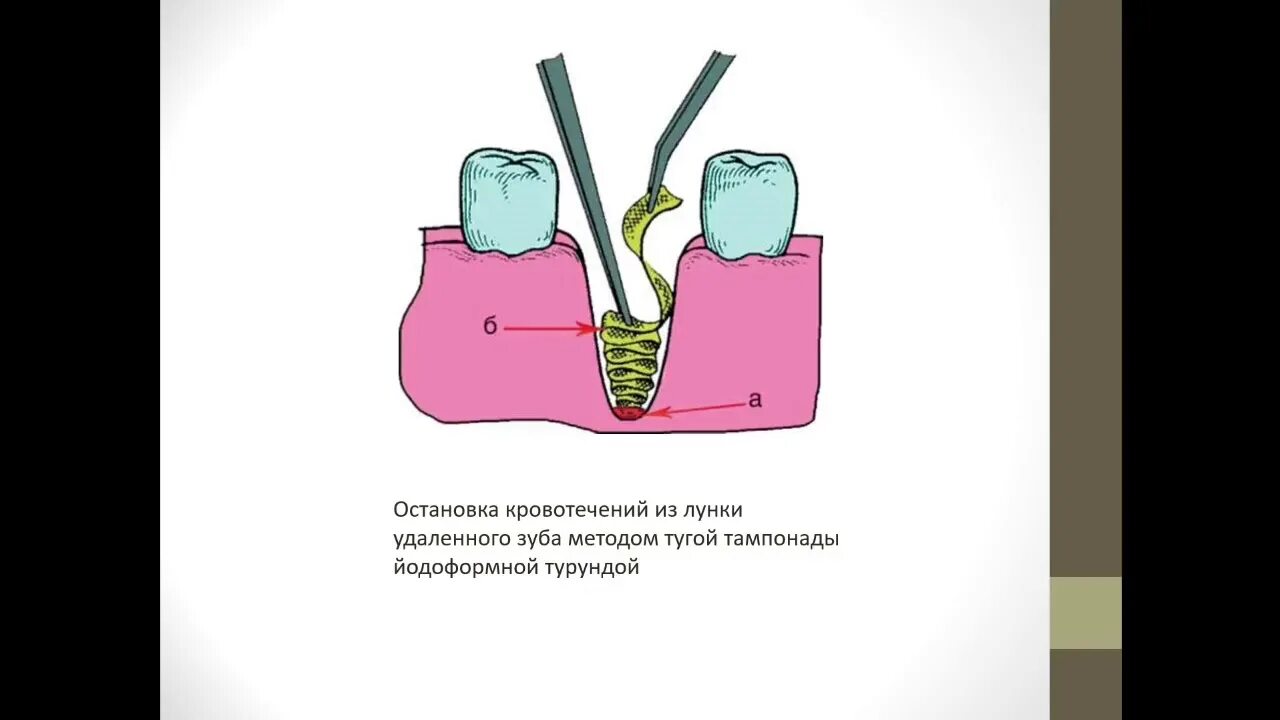 Остановить кровотечение удаления зуба. Остановка кровотечения из лунки удаленного зуба. Турунда йодоформная в лунку зуба. Турундв для удаленного зуба. Губка с йодом в лунку зуба.