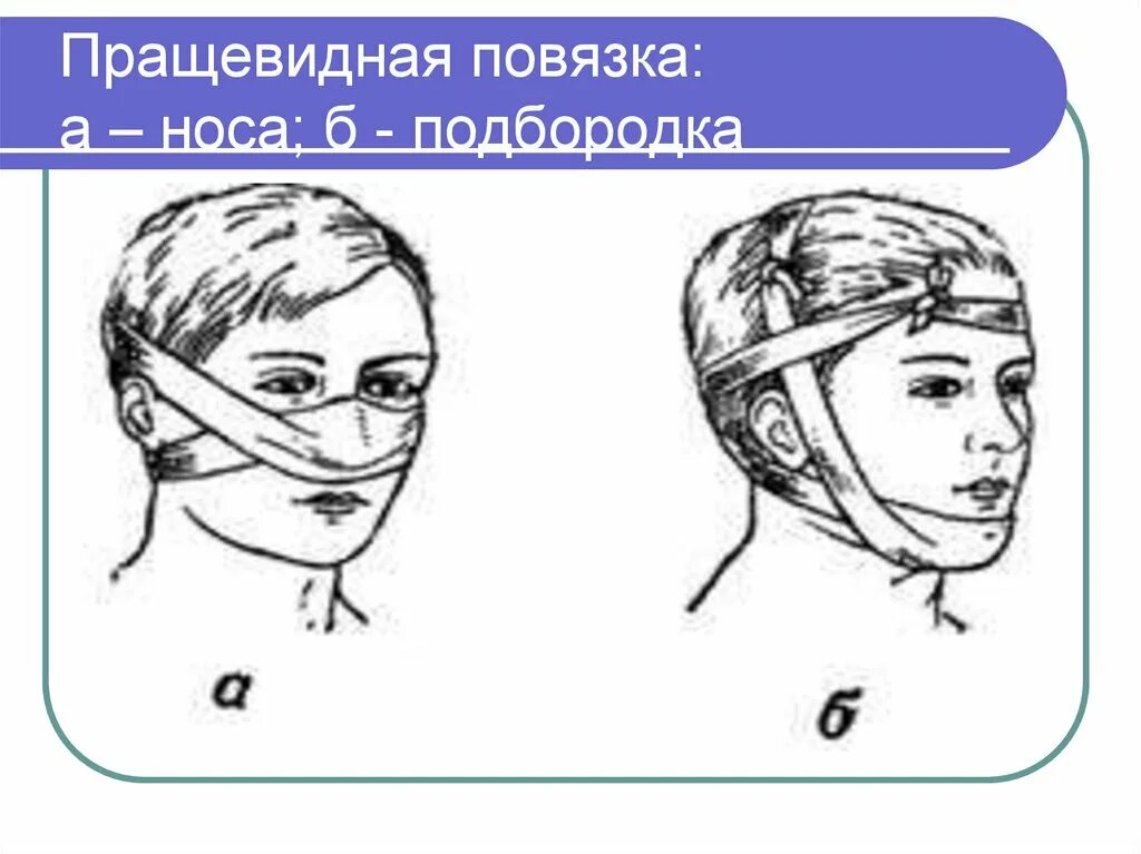 Техника наложения пращевидной повязки