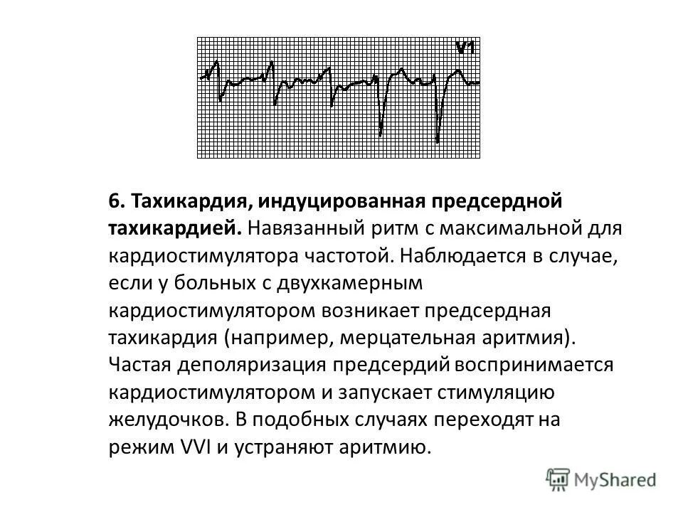 Ритм кардиостимулятора. Фибрилляция предсердий на ЭКГ. Предсердная стимуляция. Мерцательная аритмия кардиостимулятор.