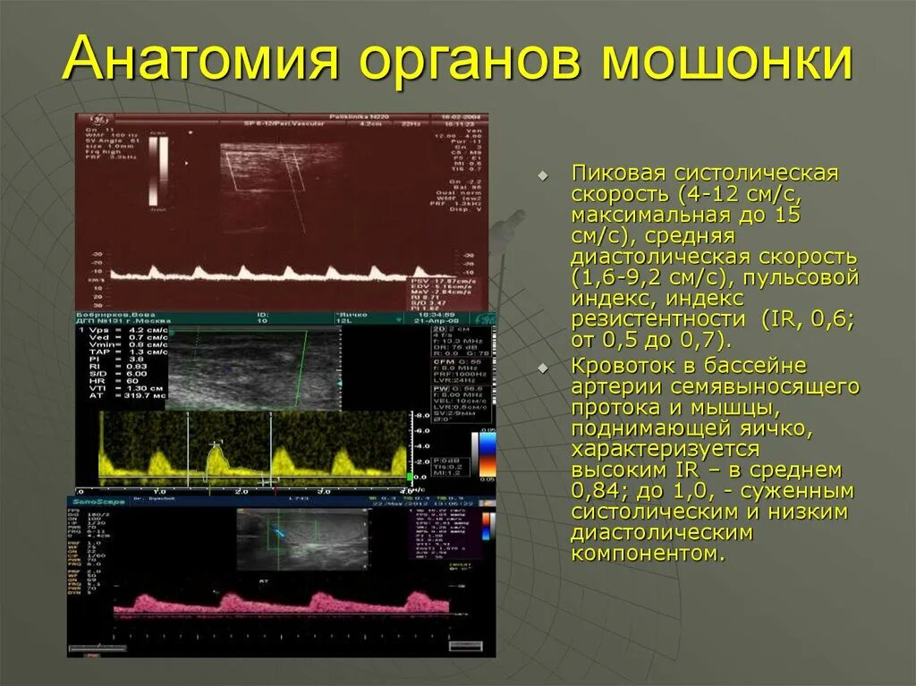 Ультразвуковое исследование органов мошонки. Нормы ультразвукового исследования мошонки. УЗИ органов мошонки норма. Ультразвуковая анатомия мошонки. Индекс резистентности артерий