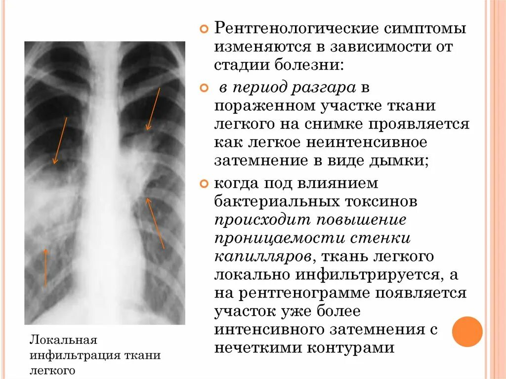 Очаговый бронхит. Рентген при двусторонней пневмонии. Рентген легких пневмония протокол. Внебольничная пневмония рентген.