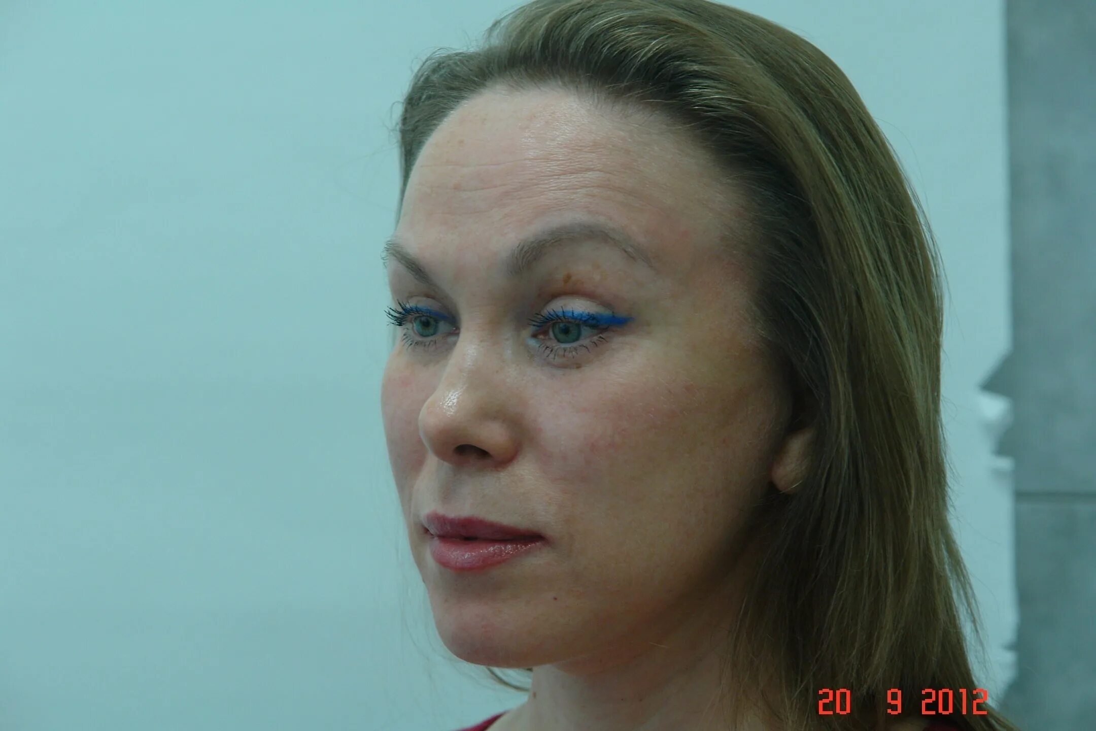 Липосакция на Body Tite. Радиочастотная липосакция. Клиника Beauty Trend