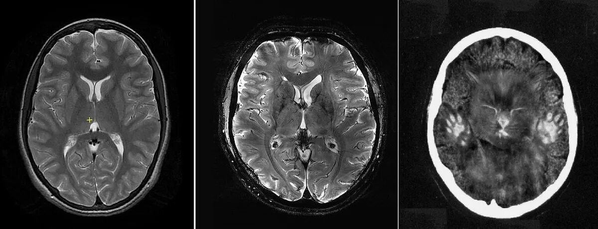 Патологии на мрт. Снимки мрт головного мозга норма. Снимок мрт головного мозга в норме. Мрт снимки мозга норма. Мрт ГМ норма.
