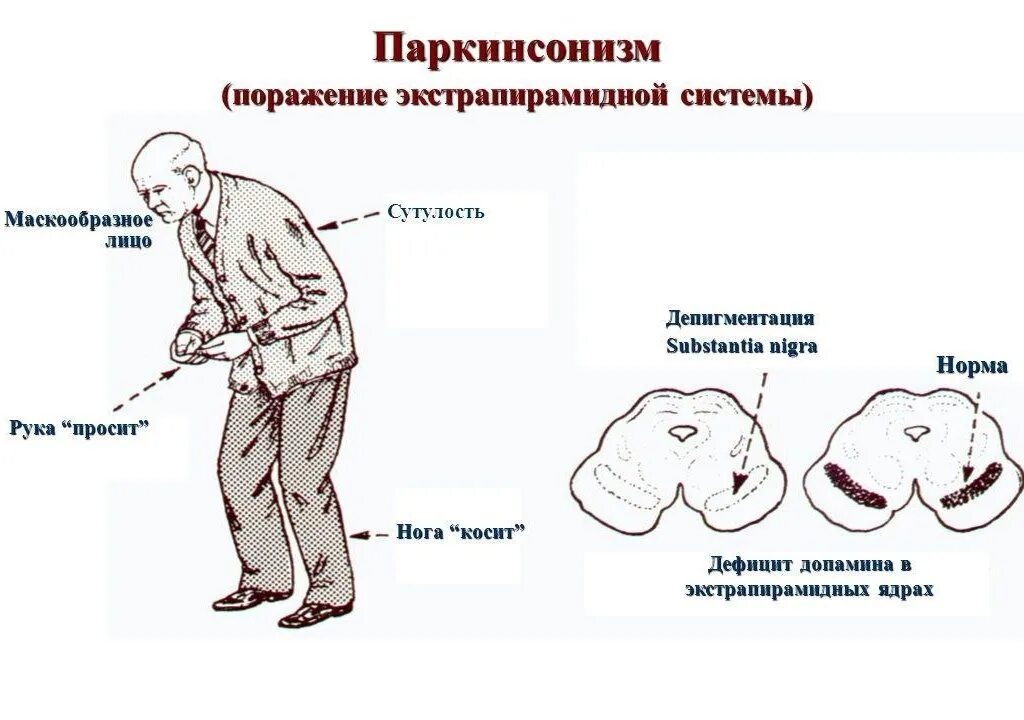 Поражение это простыми словами. Болезнь Паркинсона неврология симптомы. Клинические симптомы при болезни Паркинсона. Болезнь Паркинсона очаг поражения. Синдромология болезни Паркинсона.