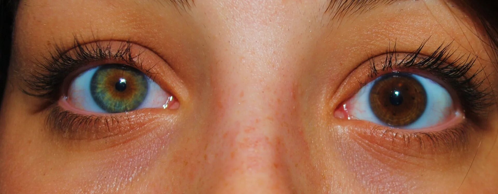 почему один глаз темнее другого