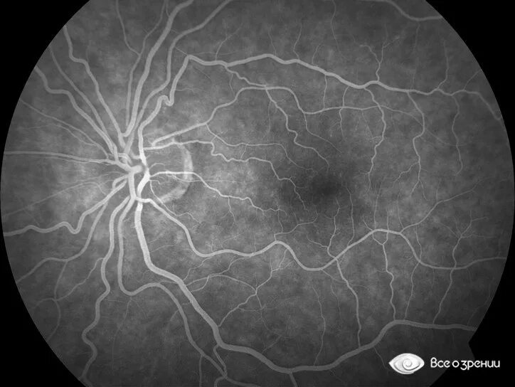 Ангиодистония сосудов. Ангиодистония сетчатки ou. Флуоресцентная ангиография сетчатки глаза (фаг). Флюоресцентная ангиография глаза. Ангиодистония сетчатки обоих глаз.