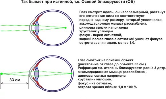 Минус и плюс в зрении. Оптическая система глаза при близорукости. Острота зрения при гиперметропии. Состояние аккомодации глаза. Близорукость дальнозоркость астигматизм.