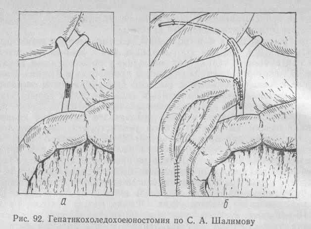 Непроходимость желчных путей. Непроходимость желчного протока. холецистоэнтероанастомоз по шалимову.