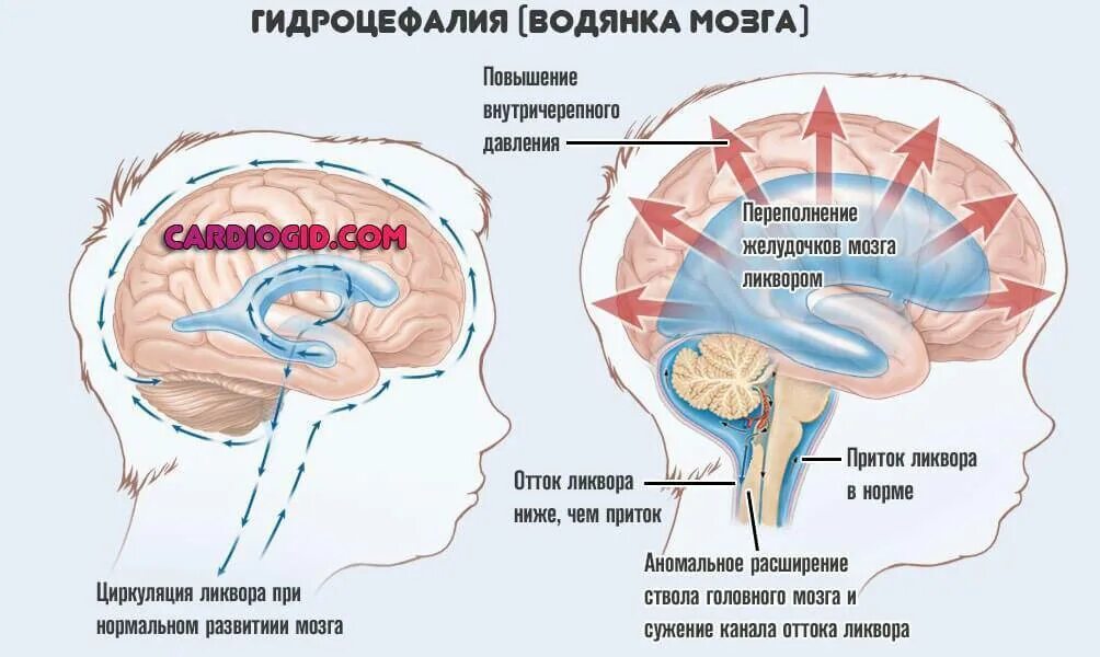Внутричерепное давление у грудничка симптомы. Внутренне черепное давление симптомы. нарушение оттока спинномозговой жидкости. клинические симптомы гидроцефалии. патологические изменения спинномозговой жидкости при гидроцефалии.