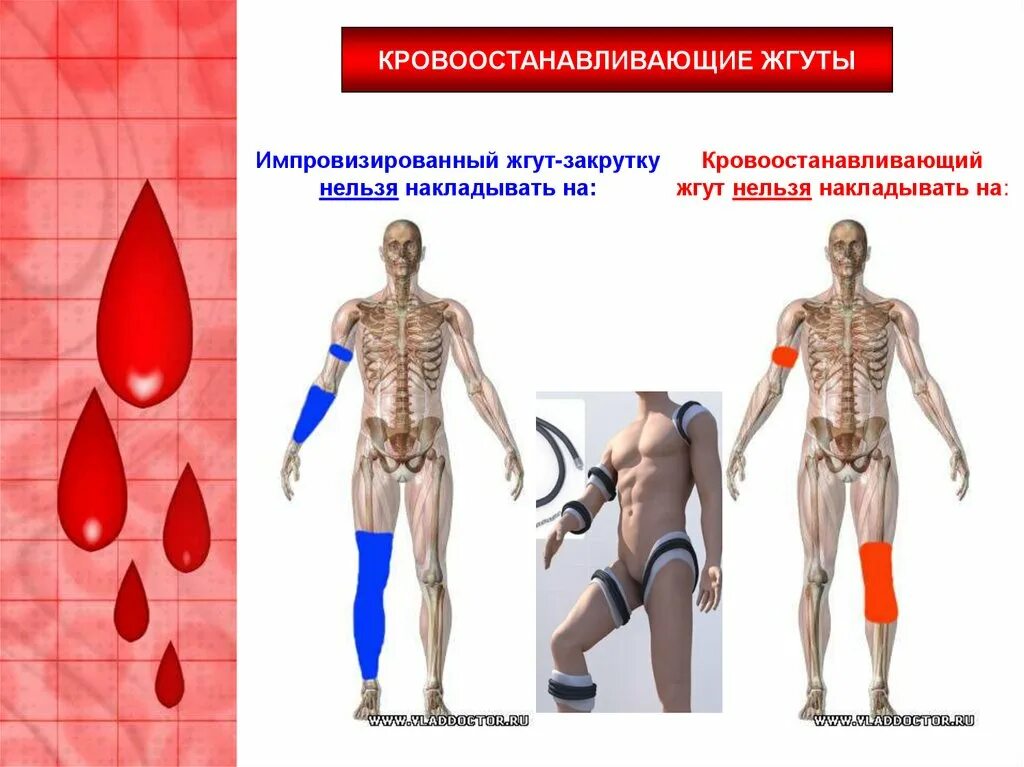 Назовите 6 основных правил наложения жгута. Жгут нельзя накладывать на. Как накладывается жгут. Ошибки при наложение дгута. Жгут нельзя накладывать на.