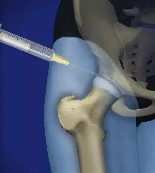 Пункция тазобедренного сустава техника. Внутрисуставная блокада тазобедренного сустава. Тендиноз тазобедренного сустава что это такое. Внутрисуставное Введение в тазобедренный сустав. Медицина суставы тазобедренный