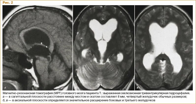 Операция гидроцефалия мозга. Окклюзионная гидроцефалия мрт. Гидроцефалия головного мозга мрт. Тетравентрикулярная гидроцефалия мрт. Наружная гидроцефалия головного мозга мрт.
