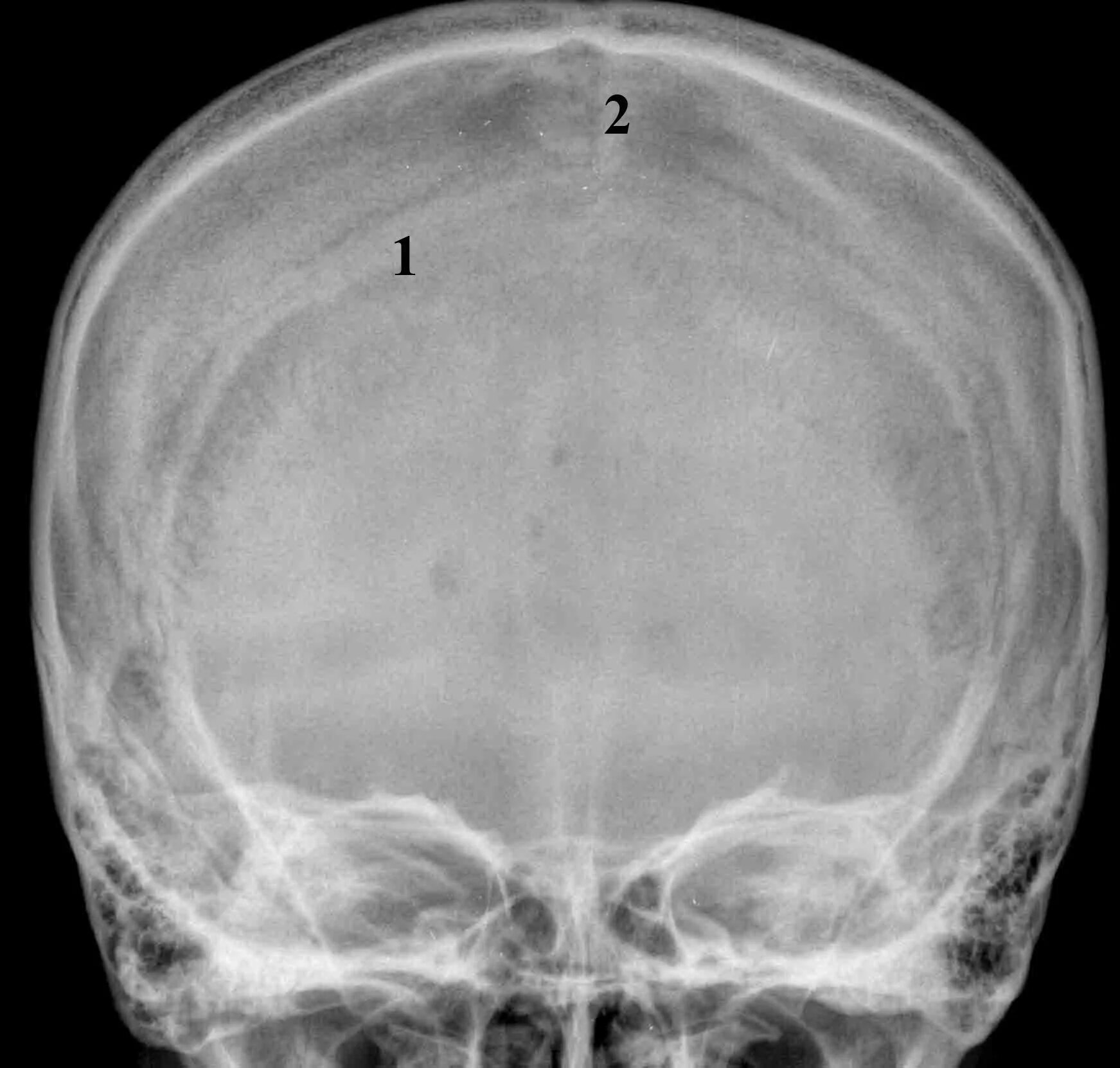 Кости черепа рентген. Менингиома рентген черепа. Пахионовы грануляции рентген черепа. Пахионова грануляция лобной кости.
