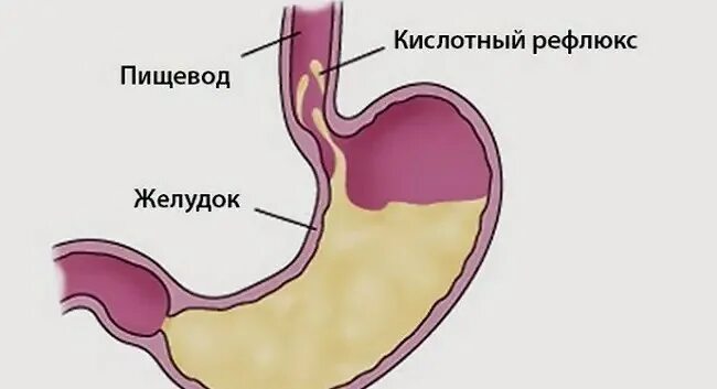 Заброс содержимого желудка в пищевод. Желудочно-пищеводный рефлюкс. Эзофагит рефлюкс кислотный. Гастрит рефлюкс эзофагит.