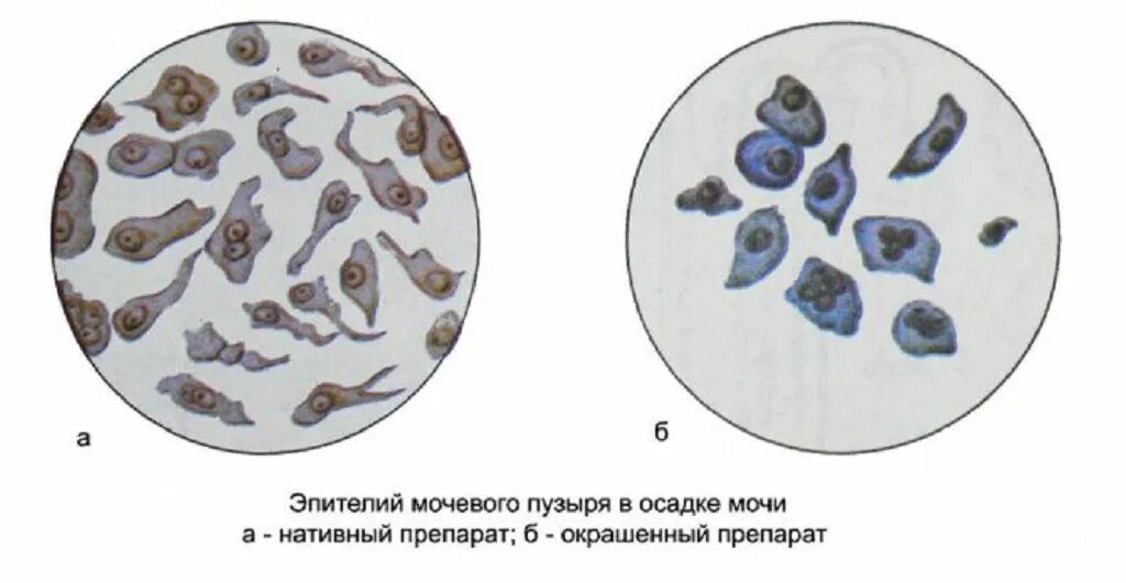 Плоский эпителий в моче микроскопия. Плоский переходный и почечный эпителий в моче. Микроскопия мочи почечный эпителий. Микроскопия осадка мочи переходный эпителий. Повышенный эпителий в моче у мужчин