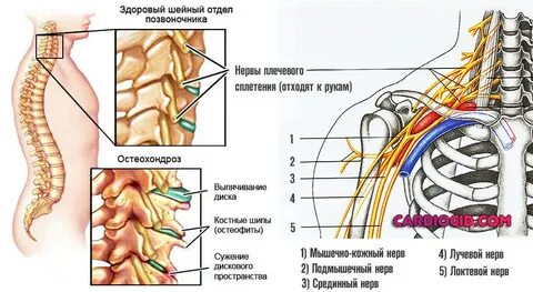 Онемение при остеохондрозе