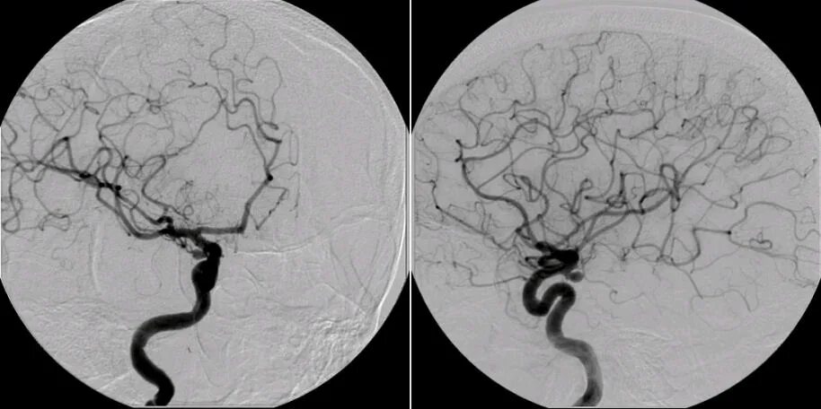 Форум аневризма мозга. Аневризма головного мозга на кт. Саккулярная аневризма. Микотическая аневризма. Тромбированная аневризма кт.
