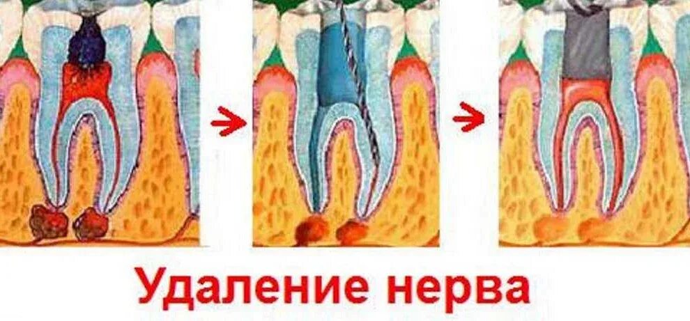 После удаления нерва болит зуб при нажатии. После удаления нерва болит зуб при нажатии
