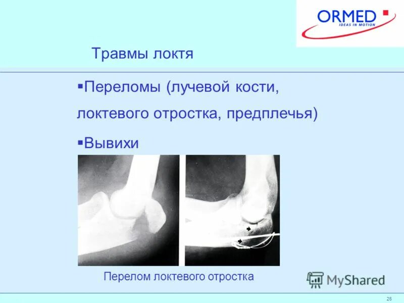 Переломы костей локтевого сустава классификация. Перелом локтевого отростка иммобилизация. Многооскольчатый перелом локтевого отростка. Перелом локтевого отростка код по мкб 10. Операции при переломе венечного отростка локтевого сустава.