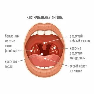 Чем лечить ангину у ребенка