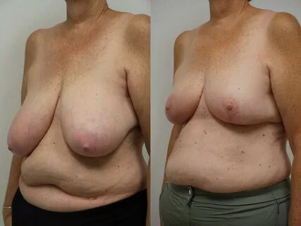 Before & After Breast Reduction Case 106 View #1 View in Gilbert, AZ.