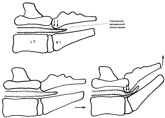 Пояснично-крестцовый стеноз у собак. Люмбосакральный стеноз. Дегенеративный люмбосакральный стеноз. Люмбосакральный стеноз у собак. Крестцовый стеноз