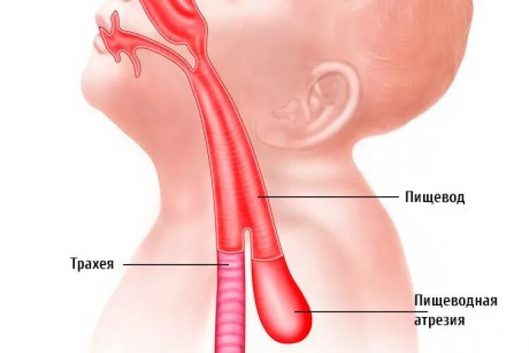 Анатомия трахеи и пищевода. Врожденная патология пищевода. Атрезия пищевода с нижним трахеопищеводным свищем. Пищевод у новорожденного