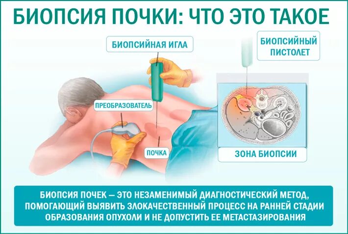 Как делают биопсию мужчинам. Пункционная биопсия почек. Методика пункционной биопсии почек. Биопсия почки как проводится. Показания к пункционной биопсии почек.