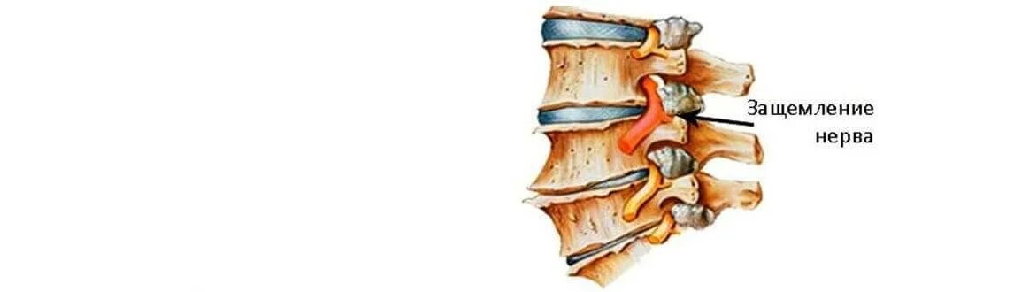 Защемление седалищного нерва. Радикулит поясничный. Защемление нервных корешков спинного мозга. Защемление спинного нерва. Защемление 5-6 позвонка поясничного отдела.