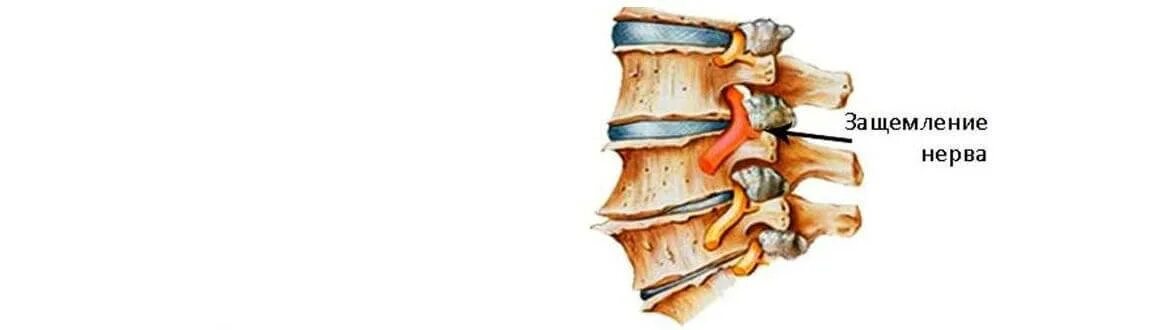 Защемление нерва в спине поясница. Защемление Корешков поясничного отдела. Защемление корешка пояснично-крестцового отдела позвоночника. Защемление 5-6 позвонка поясничного отдела. Защемление нервного корешка в поясничном отделе.