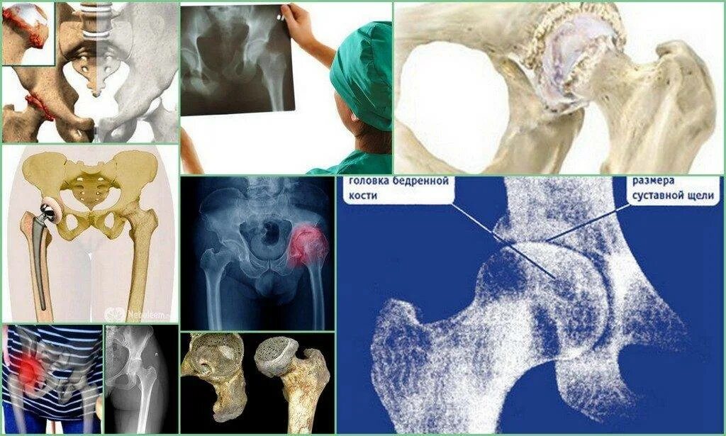 Коксартроз тазобедренного 1 степени у женщин лечение. Деформирующий артроз (коксартроз). Коксартроз (артроз тазобедренного сустава). Деформирующий артроз тазобедренного сустава кт.