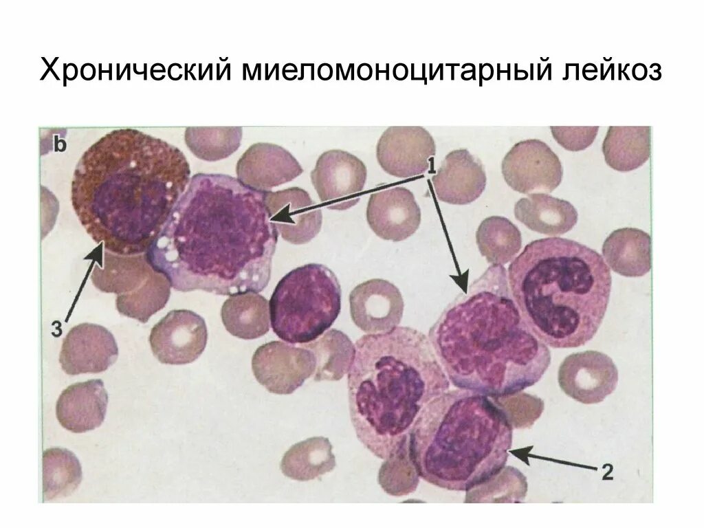 Острый миелоидный лейкоз картина крови. Хронический миеломоноцитарный лейкоз картина крови. Острый моноцитарный лейкоз. Миеломоноцитарный лейкоз хронический лейкоз. Хронический лимфолейкоз рекомендации