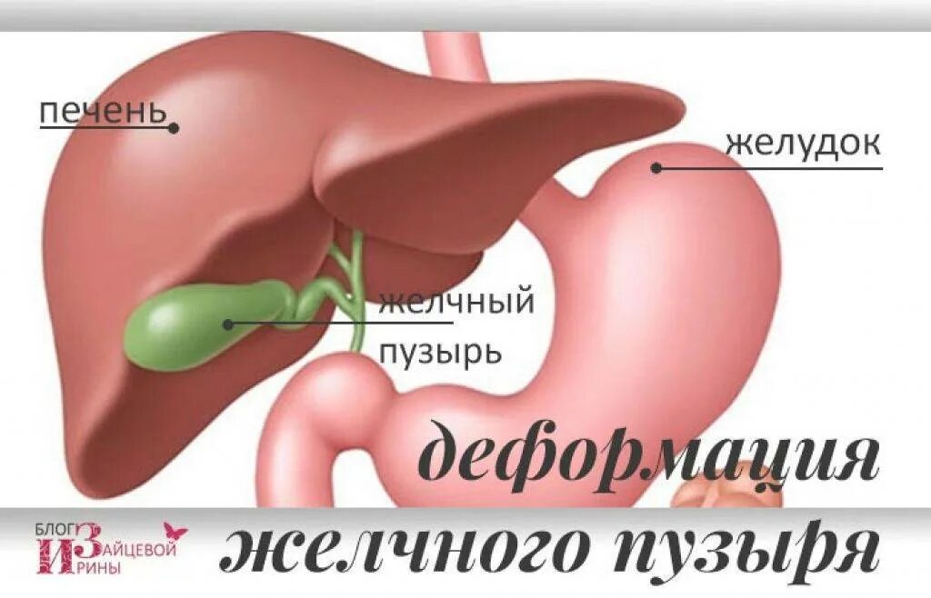 Желчный пузырь неправильной формы. Деформация желчного пузыря. Деформированный желчный пузырь. Деформирование желчного пузыря. Дисформия желчного пузыря.